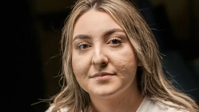 Trądzik – rodzaje i możliwe przyczyny powstawania